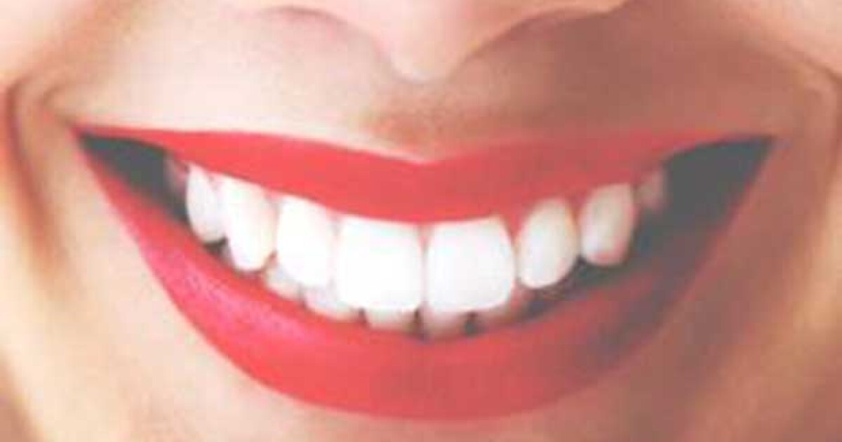mejor tratamiento para blanquear dientes